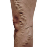 Picture of Leg Before Varicose Vein Treatment
