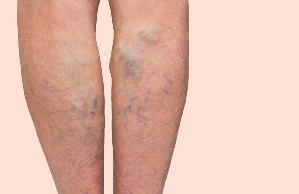 The varicose veins on a legs of old woman on gray