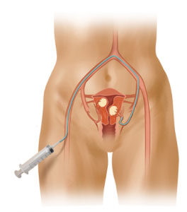 uterine fibroid emoblization illustration image