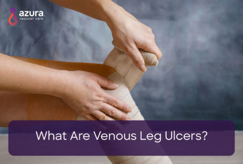 What Are Venous Leg Ulcers?
