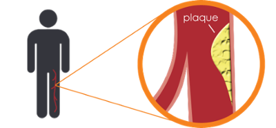 what_is_peripheral_artery_disease-1