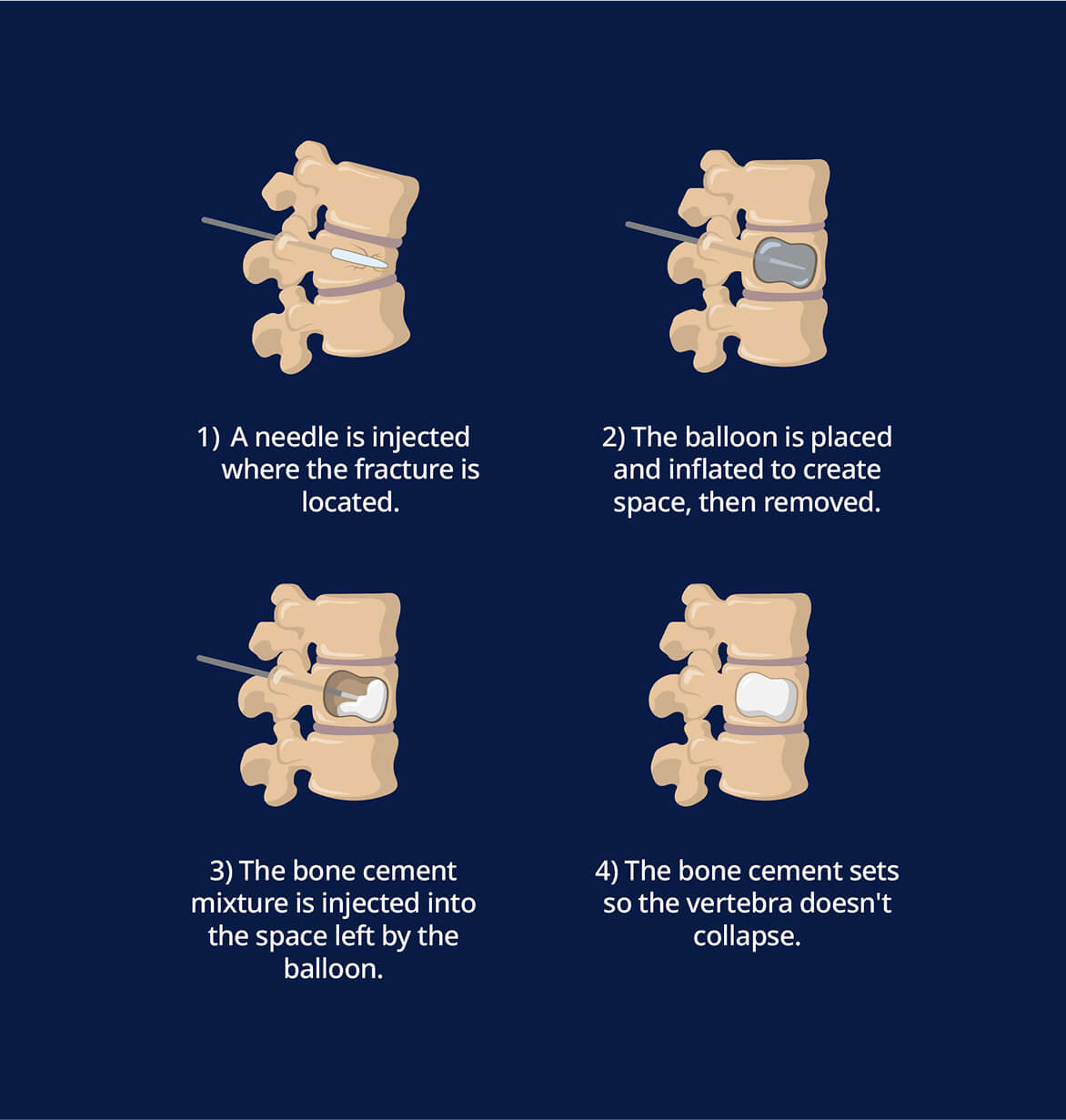 An illustration of how interventional radiologist Imagperform kyphoplasty and vertebroplasty.