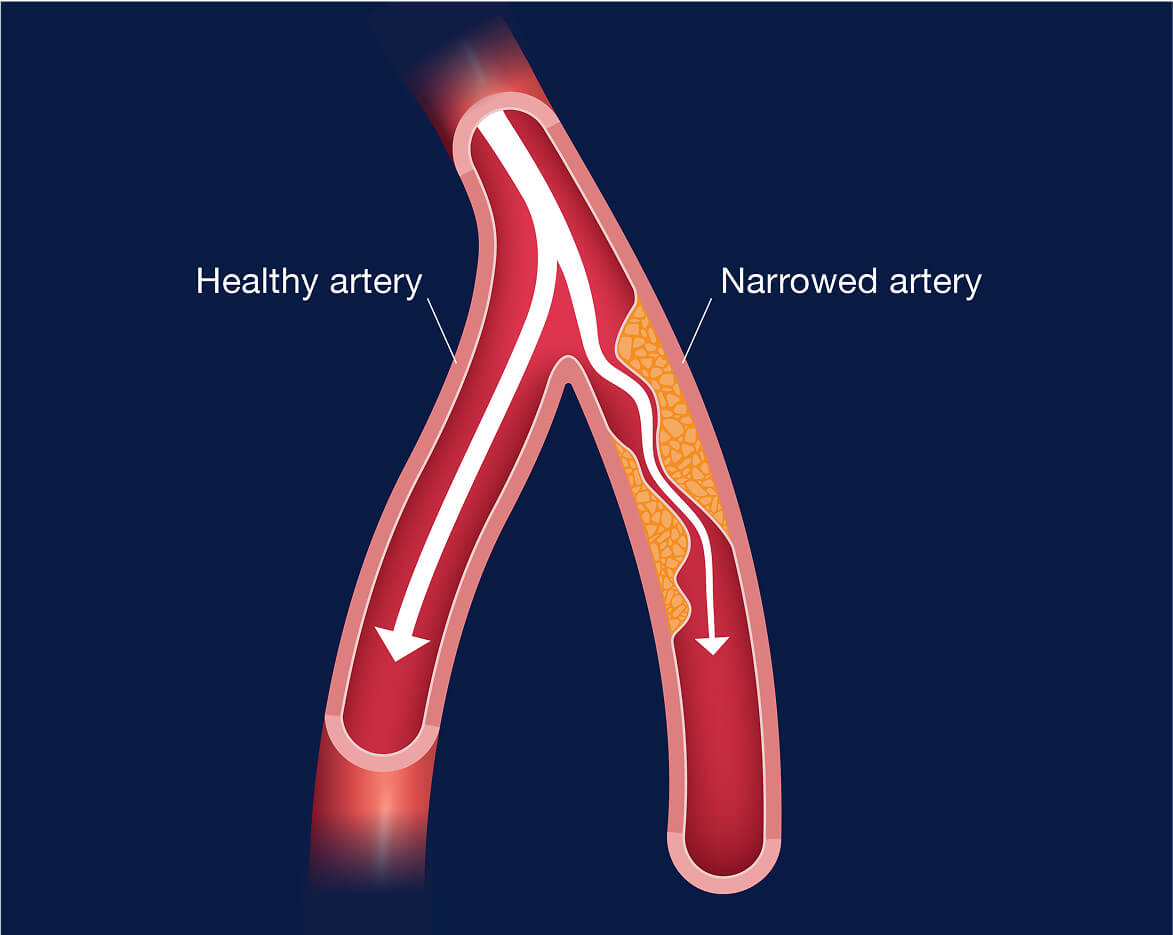 An illustration of poor blood flow, healthy artery and a narrowed artery